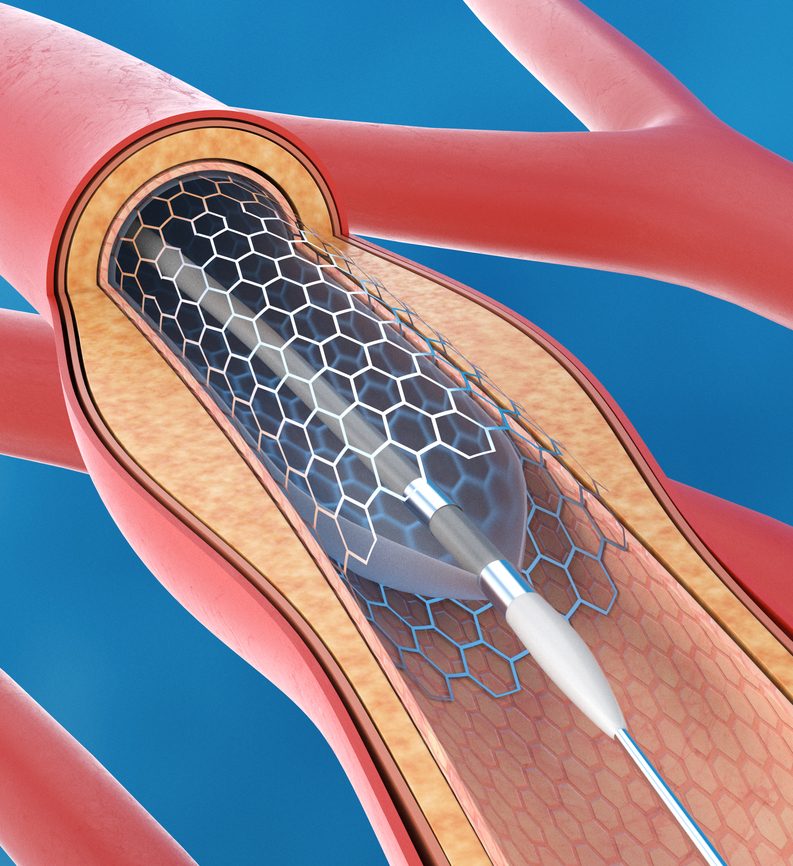 Angioplasty & Stents