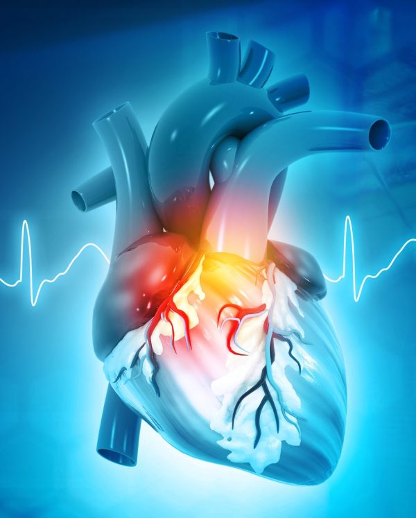 Atrial Fibrillation