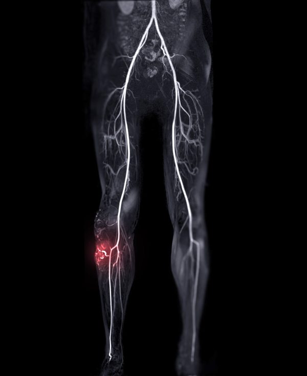 PADnet Non-invasive Arterial Testing
