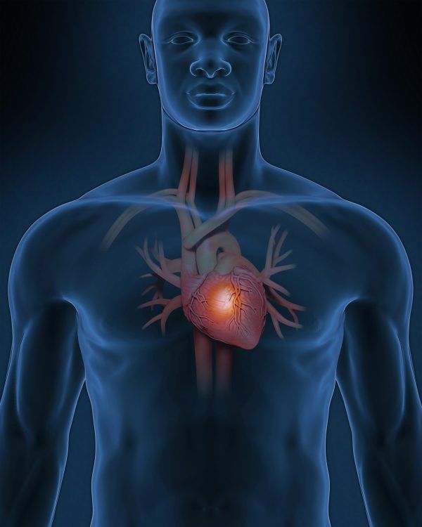 Patent Ductus Arteriosus (PFO)