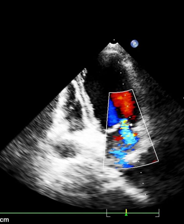 Transesophageal Echo (TEE)